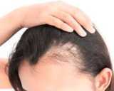 cheveux-perte.jpg cheveux-perte.jpg